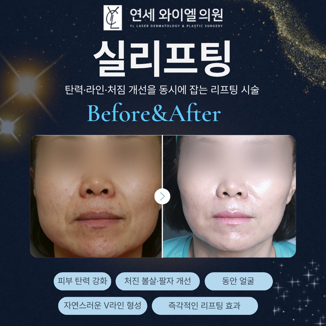 延世YL Onda 身体塑形:手臂 / 腹部 / 大腿 180kj 紧致方案